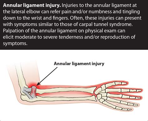 annular ligament tear test|elbow annular ligament tear symptoms.